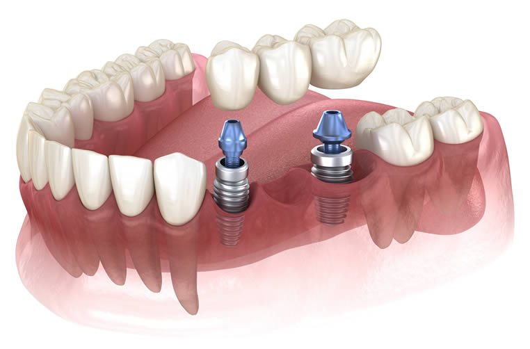Dental Implants Offer a Permanent Solution to Your Dental Problems Dental Implants Offer a Permanent Solution to Your Dental Problems